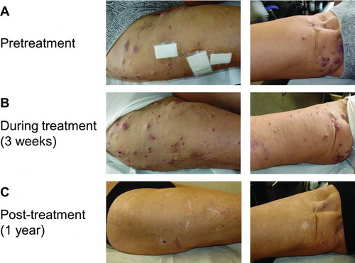 Figure 5  (A) In-transit melanoma metastases on the right leg prior to therapy with ipilimumab 3 mg/kg. (B) During the first weeks of treatment, there was an increase in size and number of the right leg in-transit lesions. C. Two months after starting ipilimumab therapy, the in-transit metastases slowly regressed and all disappeared (as illustrated 1 year after ipilimumab treatment).