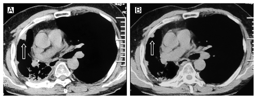 Figure 3. Tumor volume changes seen on CT (A) before the gemcitabine treatment; (B) 2 cycles after gemcitabine retreatment.