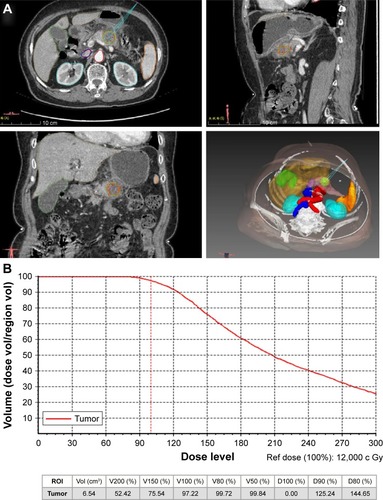 Figure 1 The preoperative treatment planning for 125I seed implantation. (A) Preoperative treatment planning using the 3D visualized seed planning and navigation system and (B) preoperative dose volume histograms. A total of 90% of the tumor target received 125.24 Gy (D90=125.24 Gy), and 97.22% of the tumor target received 100% of the prescribed dose (V100=97.22%, red dashed line). D90 and D80 represent the dose such that at least 90% or 80% of the tumor volume received the reference dose, respectively. V80–V100 are the volumes that received 80%–100% reference dose, respectively.