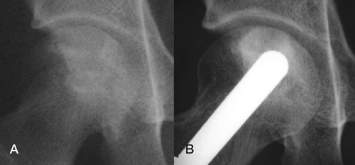 Figure 2. Right hip of a 15-year-old girl with osteonecrosis of the femoral head secondary to cortisone intake for marrow transplantation. A. Preoperatively, Steinberg stage II with HHS of 85. B. 5 years later, radiographic Steinberg staging remained unchanged and HHS was 100.