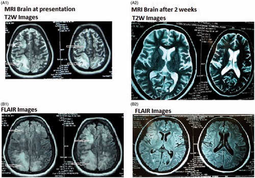 Figure 1. MRI at presentation of PRES. T2-weighted image (A1) and FLAIR image (B1) show high signal abnormalities bilaterally in the parietooccipital regions, in both subcortical white matter and cortical gray matter. MRI after 2 weeks of follow-up shows complete disappearance of all high signal abnormalities in both T2-weighted image (A2) and FLAIR image (B2).