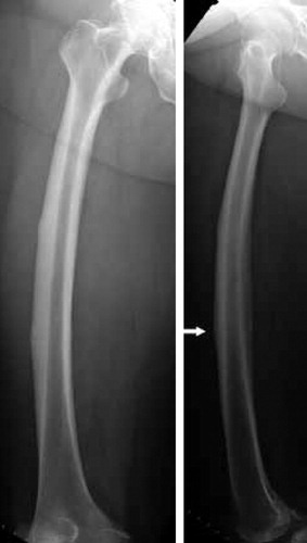 Figure 2. Right femur at 3-month follow-up showing a healing fracture (arrow).