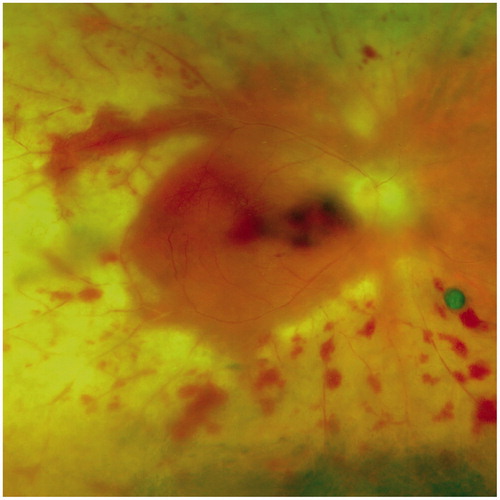 FIGURE 2. Fundoscopic photograph of the same eye with hemorrhagic occlusive vasculitis and confluent whitish areas of retinal necrosis in the peripheral ocular fundus. Note the central involvement with macular hemorrhage.