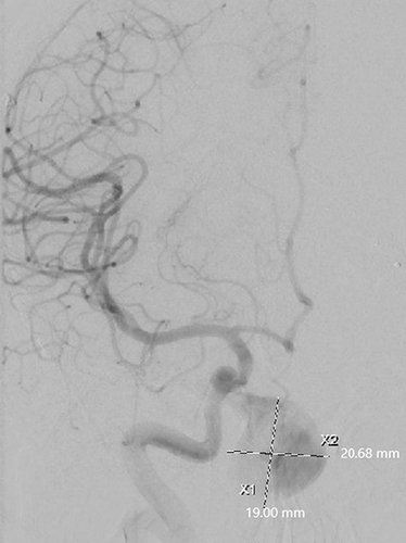 Figure 12 Cerebral angiogram showing large pseudoaneurysm of the cavernous portion of the internal carotid artery.