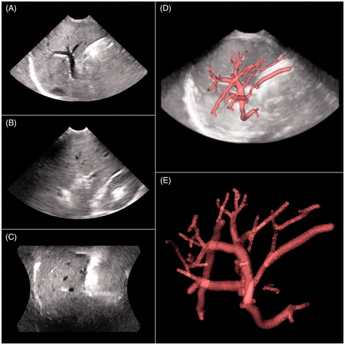 Figure 2. (A–C) Basic 3D ultrasonic images of the anterior right liver lobe in the transverse, coronal and sagittal planes. (D) Vessel tree recognition. (E) Vessel tree segmentation and extraction.