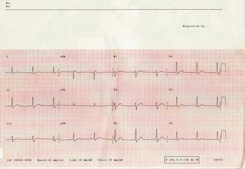 FIGURE 2.  ECG showing normal cardiac rhythm and QT interval after amiodarone administration