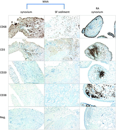 Figure 2. Immunohistochemical findings. Immunohistochemical stains for CD68, CD3, CD20 and CD38. Chromogen, DAB (brown). Original magnification, 100×. Left panel: synovial biopsy from patient 1. Middle panel: paraffin-embedded synovial fluid sediment from patient 1. Right panel: synovial biopsy from a patient with RA with active disease despite treatment with disease-modifying antirheumatic drugs.