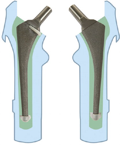 Figure 2. Femoral components. A proximal centralizer on the left stem (investigational group) and distal centralizers on both stems.