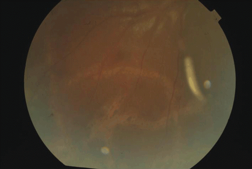 FIGURE 3  Color fundus photograph showing larva in the vitreous cavity along with multiple subretinal tracks.