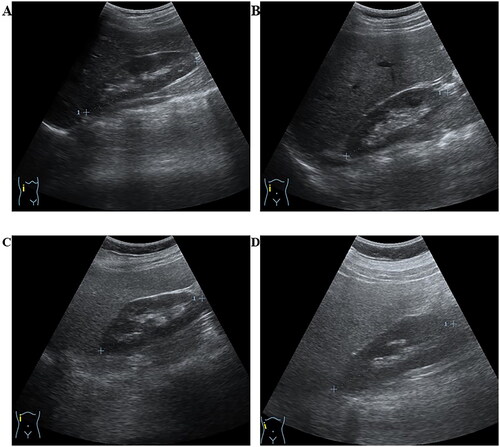 Figure 1. Ultrasound imaging depicting stages of steatotic liver disease (SLD). The figure presents ultrasound images illustrating steatotic liver conditions in four different participants in this study. Liver steatosis was assessed by qualitatively comparing the echogenicity of the liver parenchyma to the echogenicity of the right kidney [Citation20]. (A) Normal liver, (B) Mild liver steatosis, (C) Moderate liver steatosis, and (D) Severe liver steatosis. The grading criteria for fatty liver included diaphragm images, which are not depicted in this figure.