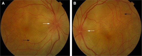 Figure 3 Color retinal photographs of right (A) and left eye (B) showing swollen and hyperemic optic discs (white arrows), with choroidal folds disc (black arrows), in the acute phase of VKHD.