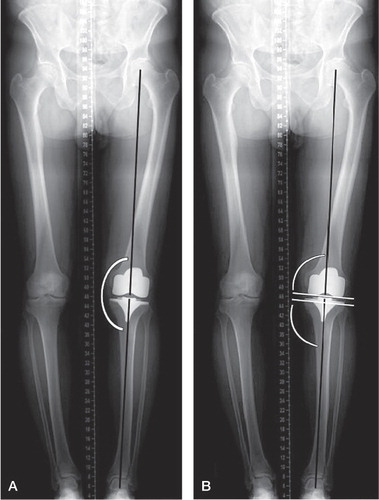 Figure 4 A. long-leg radiograph. Mechanical axis of the leg measured on a standing long-leg radiograph as the medial angle between the mechanical axis of the femur, defined as the line between the center of the hip and the center of the femoral component, and the mechanical axis of the tibia, defined as the line between the center of the tibial component and the center of the ankle. B. Long-leg radiograph. FFC and FTC angles were measured as the medial angles between the femoral component and the mechanical axis of the femur and between the tibial component and the mechanical axis of the tibia, respectively.