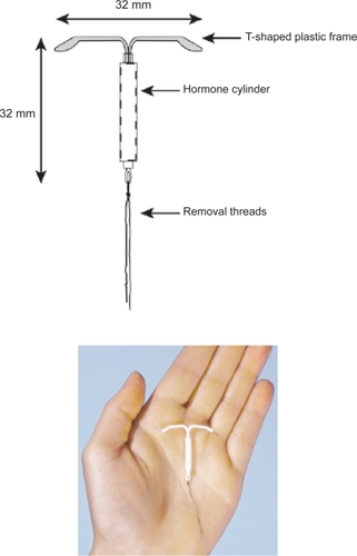 Figure 1 The levonorgestrel-releasing intrauterine system device.