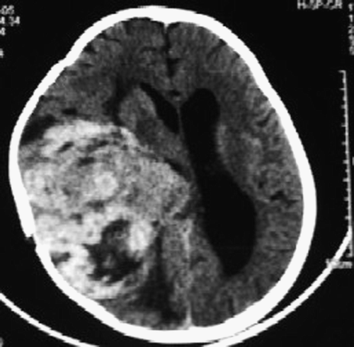Figure 1.  CT scan of head of patient 1 showing a large recurrent right temporoparietooccipital tumor with mass effect and midline shift.