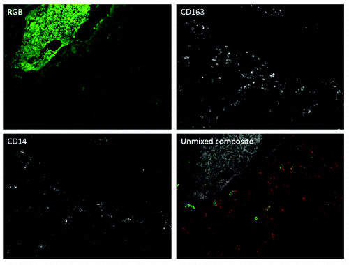 Figure 1. Osteosarcoma samples are infiltrated with CD14 and CD163 single and double positive macrophages. Spectral imaging was used to reduce autofluorescence of osteosarcoma cells. In the composite image, CD14-positive cells are represented in green, CD163-positive cells are represented in red, and CD14/CD163 double positive cells are represented in yellow. Background autofluorescence of tumor cells is represented in gray.