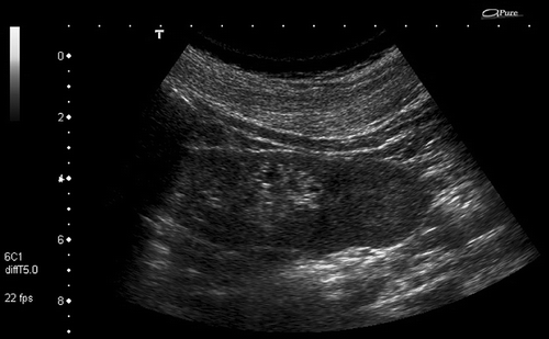 Figure 1. Renal ultrasound showed left kidney pole with a circular iso-hyperechoic lesion sharply demarcated by the remaining parenchyma.