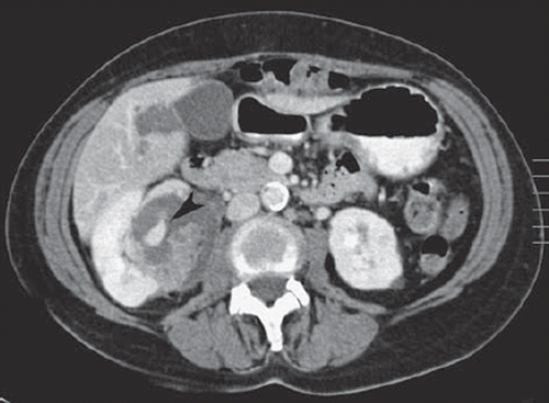 Figure 2. CT-scan of the abdomen three months after chemotherapy associated with bevacizumab reveals the appearance of a (pseudo-)aneurysm within the angiomyolipoma (black arrowhead).
