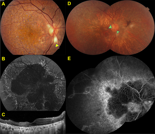 Figure 8 Incidental findings Right eye, Color fundus image (A) showing the scattered glistening crystals at the posterior pole and peripapillary myelinated nerve fiber (yellow arrow), FAF image (B) demonstrating the patchy hypofluorescent areas with ill-demarcated hyperfluorescent borders at the posterior pole in 2011. SD-OCT section (C) revealing the hyperreflective deposits at the RPE – Bruch’s membrane complex, disruption, and loss of the EZ band. Composite color fundus image (D) demonstrating the marked chorioretinal atrophy and attenuated retinal vessels with the optociliary shunt (green arrows) in 2021. Composite venous fluorescein angiographic image (E) revealing the nonperfused areas related to old central retinal vein occlusion detected in fluorescein angiography image shows extensive ischemic areas throughout posterior pole.