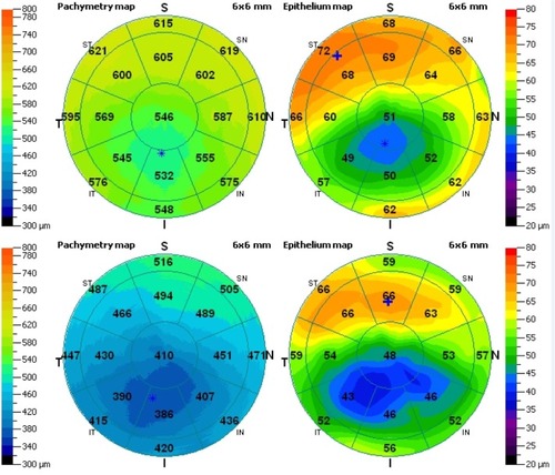 Figure 1 Total corneal (left) and epithelial (right) three-dimensional pachymetry maps. Top, a right eye with topographic variability of 8.4 μm and epithelial range of −28 μm, classified as KC2 (IHD =0.065, ISV =64); bottom, a right eye with topographic variability of 9.6 μm and epithelial range of −30 μm, classified as KC3 (IHD =0.107, ISV =104).
