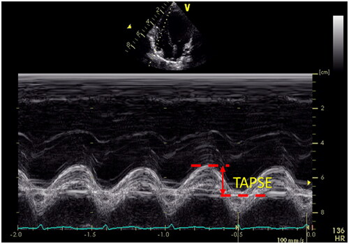 Figure 5. Tricuspid annular plane systolic excursion (TAPSE). TAPSE is a measure of RV longitudinal function and obtained from the 4-chamber view using the M-Mode with the cursor aligned along the direction of the lateral annulus.