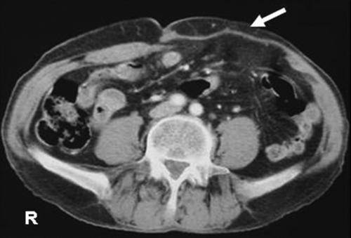 Figure 3.  Postoperative axial CT scan shows composix mesh (arrow) in the left abdominal wall.