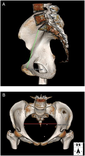Figure 1. Representative 3D CT images. Measurements of the obstetric conjugate (A) and transverse diameter of the pelvic inlet (B).