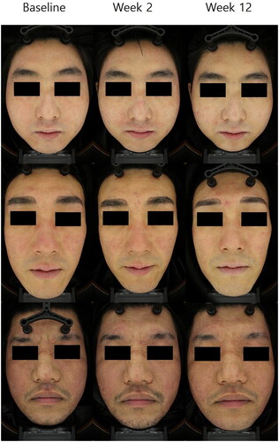 Figure 2. Representative clinical photographs of patients. Photographs were taken at baseline, at week 2 (after the first treatment), and week 12 (eight weeks after final the treatment). After exosome treatment, clinical improvements of erythema on the both cheeks, forehead, and chin were noted.