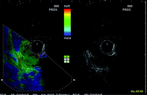 Figure 3.  The conventional 10 MHz B mode ultrasound picture is shown to the right and the sonoelastographic picture to the left. Note the colour scale indicating the strain as hard (blue to soft (red). The read and green colour of the tumour indicates that it is softer than the surrounding normal bowel wall, which is blue.