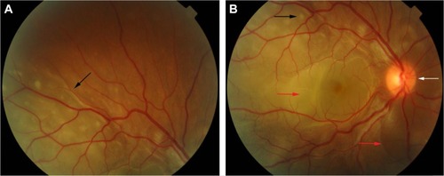 Figure 2 Color retinal photographs of a patient during the acute phase of VKHD.