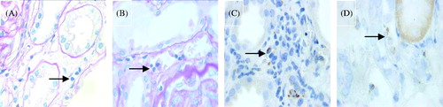 Figure 2. Example of the two PTCitis scores immunostaining for two markers (PAS stain × 1000, DAB stain × 1000). (A) Capillaritis with a PTCitis-score 1, i.e., max 3–4 luminal inflammatory cells in PTC (arrow). (B) Capillaritis with a PTCitis-score 2, i.e., max 5–10 luminal inflammatory cells in PTC (arrow). (C) CD3-positive T lymphocytes in the PTC (arrow). (D) CD68-positive macrophages in the PTC (arrow).