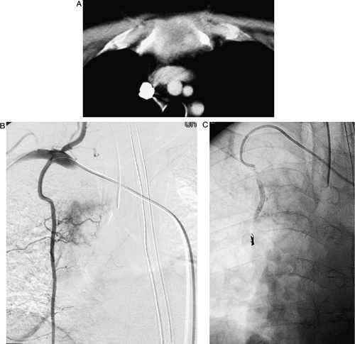 Figure 1.  Forty eight-year-old M patient who presented with constant sternal and chest pain, aggravated with movement. He required continuous intravenous narcotics and was developing respiratory depression and somnolence. A) Detail from a contrast-enhanced CT scan of the chest showing the hypervascular metastatic lesion in the manubrium. B) Angiogram performed via the internal mammary arteries (IMA). The metastasis received blood supply from both the right and left IMA. C) Post-embolization angiogram of the right IMA following embolization with 45–150 uM PVA. Microcoils were deployed distally in the IMA to redirect PVA particle flow into the small feeding vessels. The left IMA injection showed a similar elimination of the tumor stain. On the morning following the procedure, the patient had his intravenous narcotics discontinued, was awake and alert, and was able to move without further pain.