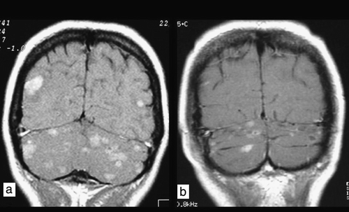 Figure 3.  Coronal T1W contrast-enhanced image. Patient 3. a) Magnetic resonance imaging scan of multiple occult subtentorial and supratentorial metastases before radiotherapy. b) Partial remission 3 months after whole-brain radiotherapy.