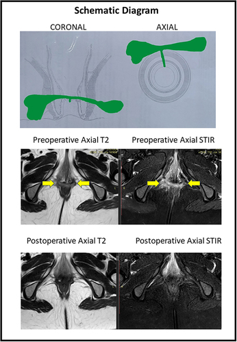 Figure 3 A 33-year old female patient with anterior horseshoe, anterior anal fistula and a RVF-II fistula. She underwent a fistulotomy. Upper panel: Schematic diagram of coronal (left side) and axial sections (right side). Middle panel: Preoperative magnetic resonance imaging - Axial sections: T2 weighted (left side) and Short Tau Inversion Recovery (STIR) (right side) (yellow arrows showing fistula tract). Lower panel: Postoperative magnetic resonance imaging- 3 months after surgery - Axial sections: T2 weighted (left side) and Short Tau Inversion Recovery (STIR) (right side showing the complete healing of the fistula.