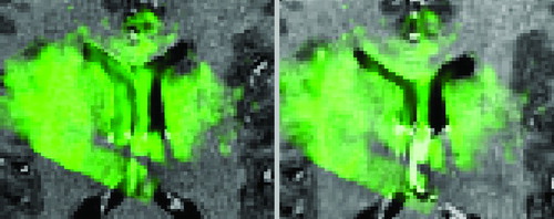 Figure 7. Case from Figure 6 illustrating US (in green) after dura opening over original MRI (left) and over corrected MRI (right). Notice the distinct collapse of the left lateral ventricle.