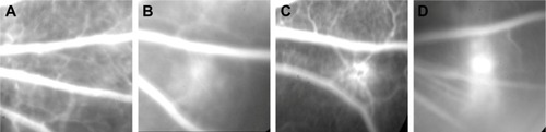 Figure 8 Fundus fluorescein angiography images of the CNV.Notes: (A) Normal structure of rat eye by intraperitoneal injection of sodium fluorescein before photocoagulation; (B) 7 days after photocoagulation; (C) 14 days after photocoagulation; and (D) 21 days after photocoagulation.Abbreviation: CNV, choroidal neovascularization.