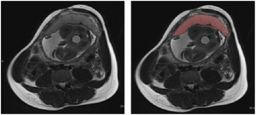Figure 2. Axial HASTE image through the placenta, prior to (left image) and after (right image) semiautomated segmentation.