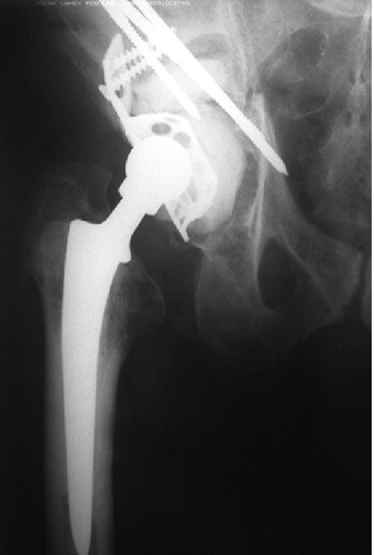 Figure 3. Six months postoperatively: note the appearance of the most medial pin projecting beyond the medial acetabular border (marked with an arrow). There was no definite pin migration at that point.