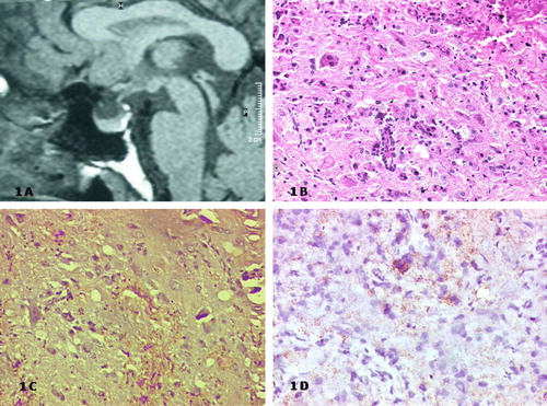 Figure 1.  A) Sagittal T1 weighted non-contrast MRI showing hypointense lesion in the pituitary; B) Conventional light microscopy (H & E) of the lesion showing pituitary epithelial cells admixed with bipolar ganglion cells in a glial background (×10); C) Photomicrograph showing synaptophysin positivity D) and background GFAP staining suggestive of glio-neuronal differentiation (×10)
