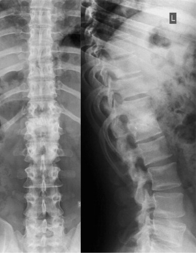 Figure 4. Postoperative image after an AO type B2.3 fracture of L1. Anterior spondylodesis resulted in solid fusion 2 years postoperatively, and the posterior instrumentation was therefore removed. The autologous rib grafts were incorporated and partially remodeled. There were no signs of lucency or resorption.