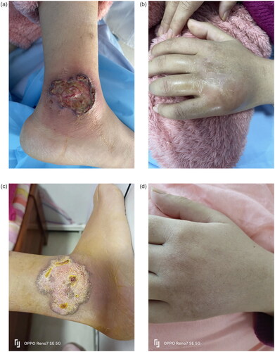 Figure 1. Ulcerated plaque on the lower extremity and left hand. (a) The ulcer on the right lower leg. (b) Swelling on the back of left hand. Figure 1(c,d) 2 Months after treatment with certolizumab. (c) The right lower leg. (d) The back of left hand.