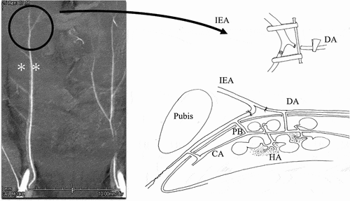 Figure 2. Microvascular anastomosis between the distal end of the inferior epigastric artery and the dorsal artery of the penis.