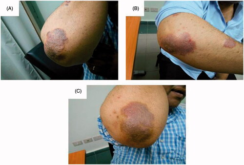 Figure 2. Assessment of the right elbow psoriatic lesion treated with MTX microemulsion formulation/fractional erbium:YAG laser along the treatment course for patient 1: (A) before treatment, (B) after 3 weeks of treatment and (C) after 8 weeks of treatment.