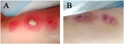 Figure 1. Skin examination. (A) Initial presentation with three inflammatory pimples and right lower limb erythema, warmth, tenderness. (B) healed lesion leaving dark pigmentation.