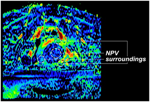 Figure 1. Example ROI placement for intensity and CNR analysis between the IVIM-based non-perfused volume (NPV) and surrounding tissue. This example shows an f-map calculated with least-squares fitting without T2-correction.