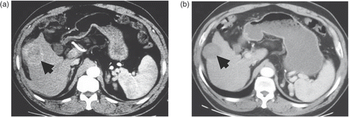 Figure 2. Transverse contrast-enhanced CT scans in patient 1. (a) Pre-ablation scan showed a 6.1 × 5.2 cm cancer nodule (indicated by the wide arrow) in the right lobe. (b) Scan obtained two weeks after one session of ablation showed a complete ablation with a 4.9 × 4.3-cm coagulation zone (indicated by the wide arrow).