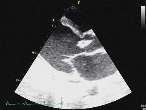 Figure 2. The transthoracic echocardiogram showed vegetation of the aortic valve.