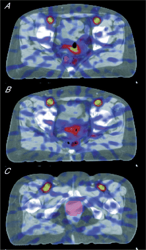 Figure 1. 3D CT scan with superimposed fused perfusion-weighted PET image shows the ROI used to estimated positions of the rectal catheter (A), vaginal catheter (B), and tumour (C).