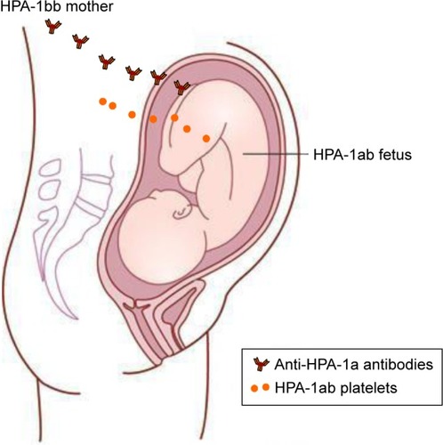 Figure 1 Pathophysiology of maternal HPA-1 alloimmunization.