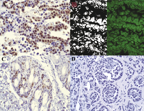 Figure 5. PCNA staining in non-viable tumor cells. Rabbit VX2 carcinoma. Strong nuclear PCNA antibody labeling (A) is observed in tumor cells within a region identified as non-viable via TTC. Fluorescent and filtered images (B) demonstrate strong autofluorescence. Control (C) with primary antibody omitted is unstained. 400× magnification.