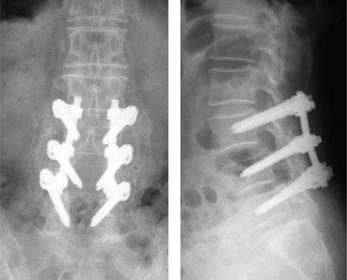 Figure 2. A 72-year-old woman with degenerative spondylolisthesis at L3/ L4 and L4/L5. Two years postoperatively, anteroposterior (A) and lateral (B) views showed stable implants and solid fusion.